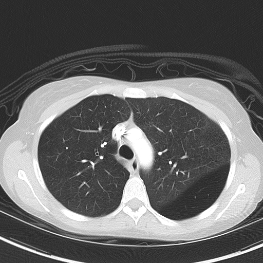 File:Bronchial atresia (Radiopaedia 73677-84470 Axial lung window 21).jpg