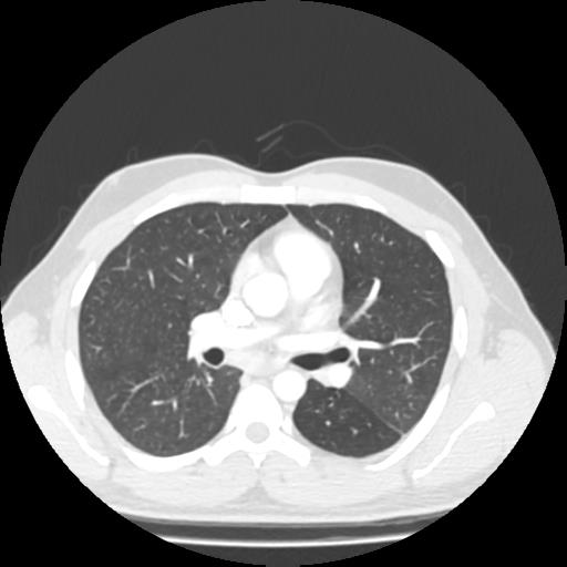 Bronchial carcinoid (Radiopaedia 80013-93291 Axial lung window 52).jpg