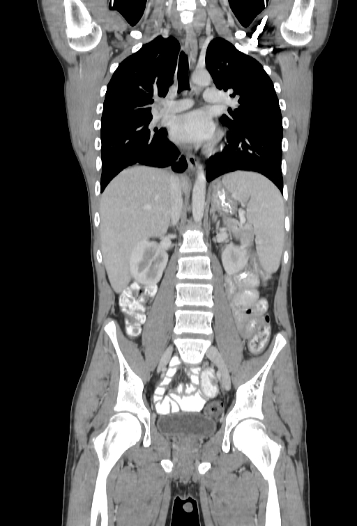 Bronchial carcinoid tumor (Radiopaedia 57187-64090 B 57).jpg