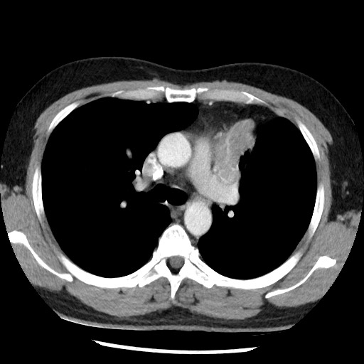 File:Bronchial carcinoid tumor (Radiopaedia 67377-76764 A 26).jpg