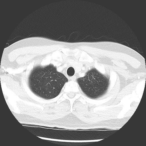 Bronchial carcinoid tumor (Radiopaedia 67377-76764 Axial lung window 12).jpg