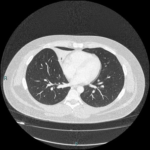 Bronchial carcinoid tumor (Radiopaedia 78272-90875 Axial lung window 31).jpg