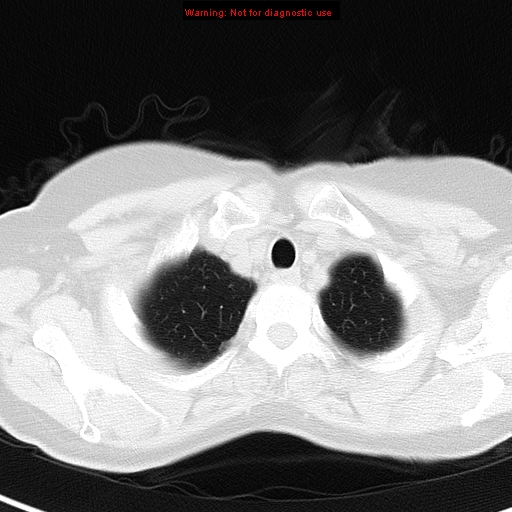 File:Bronchoalveolar carcinoma (BAC) (Radiopaedia 13436-13392 Axial lung window 5).jpg