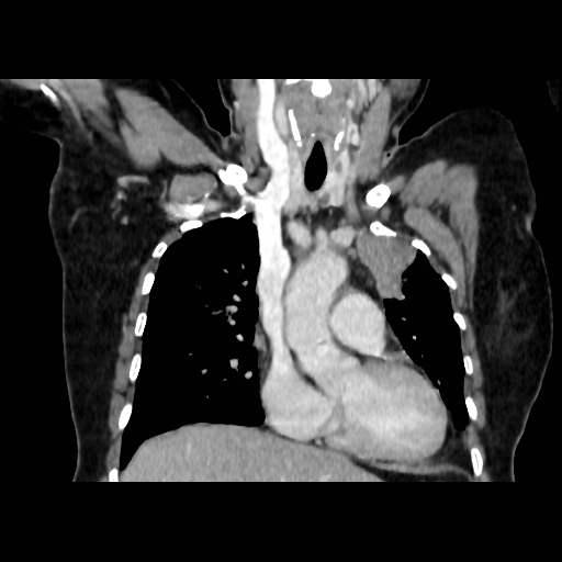 Bronchogenic carcinoma (Radiopaedia 73497-84262 C 54).jpg