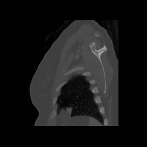 Bronchogenic carcinoma (Radiopaedia 73497-84262 Sagittal bone window 132).jpg