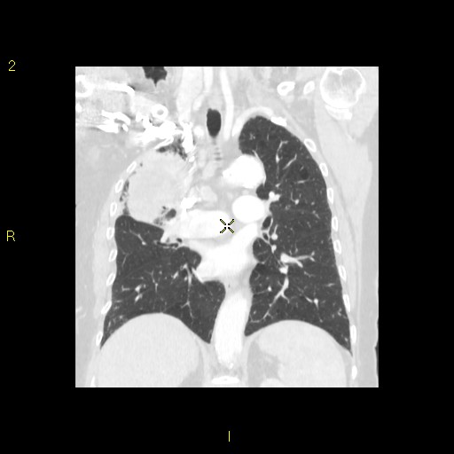 File:Bronchogenic carcinoma as an incidental finding (Radiopaedia 16453-16130 Coronal lung window 29).jpg