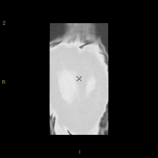 File:Bronchogenic carcinoma as an incidental finding (Radiopaedia 16453-16130 Coronal lung window 47).jpg