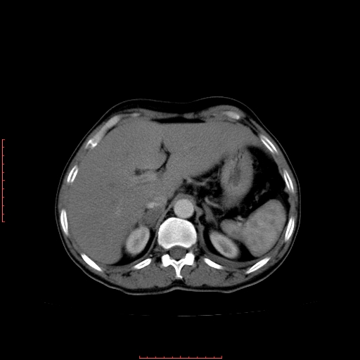 File:Bronchogenic carcinoma with left atrial large deposit - T4N3M1a (Radiopaedia 42316-45428 A 29).jpg