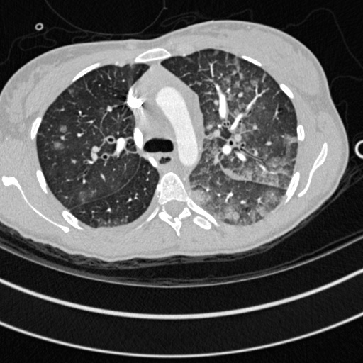 File:Bronchogenic cyst (Radiopaedia 77801-90071 Axial lung window 18).jpg