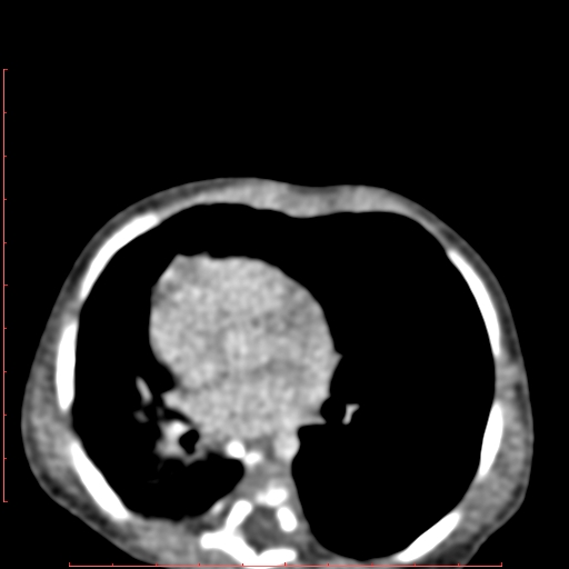 Bronchogenic cyst (Radiopaedia 78599-91409 B 114).jpg