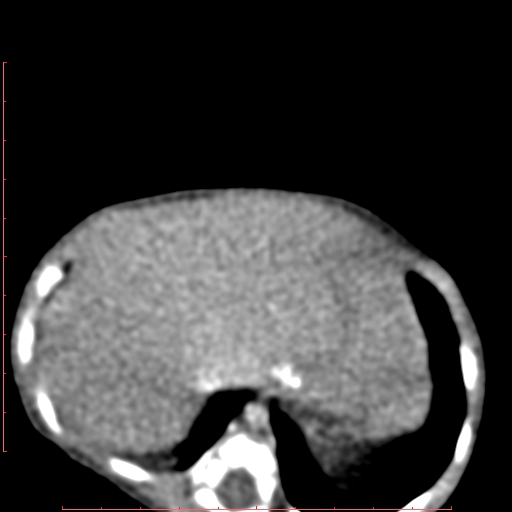 Bronchogenic cyst (Radiopaedia 78599-91409 B 176).jpg