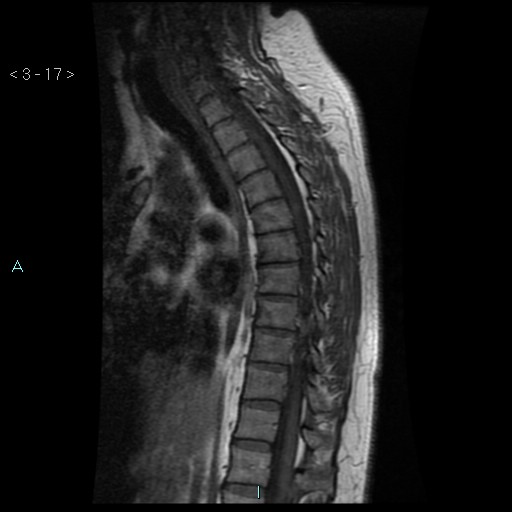 File:Bronchogenic cyst - posterior mediastinal (Radiopaedia 43885-47365 Sagittal T1 17).jpg