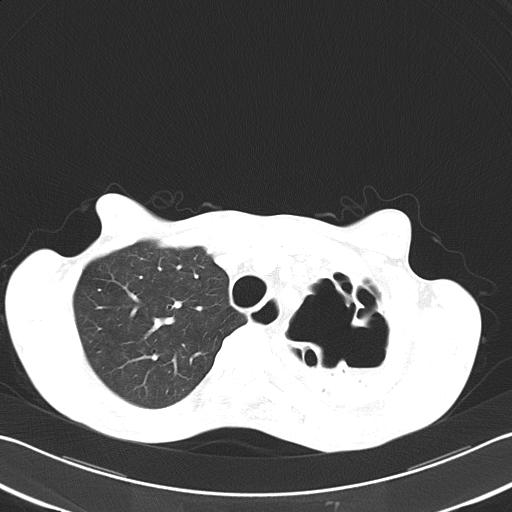 Bronchopleural fistula secondary to tuberculosis (Radiopaedia 20415-20322 Axial lung window 16).jpg