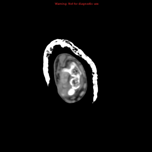 Brown tumor (Radiopaedia 12460-12694 Axial non-contrast 7).jpg