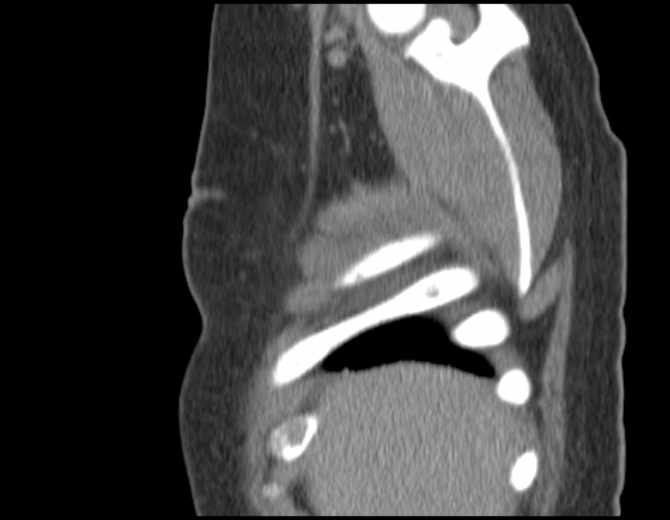 File:Brown tumors compressing the spinal cord (Radiopaedia 68442-77988 B 9).jpg