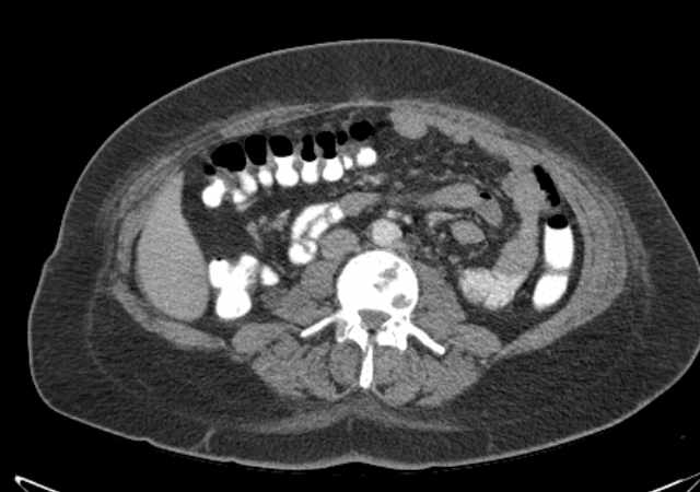 File:Brown tumors compressing the spinal cord (Radiopaedia 68442-77988 E 63).jpg