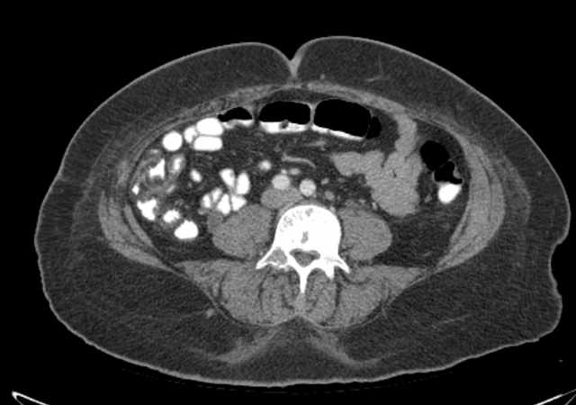 Brown tumors compressing the spinal cord (Radiopaedia 68442-77988 E 75).jpg
