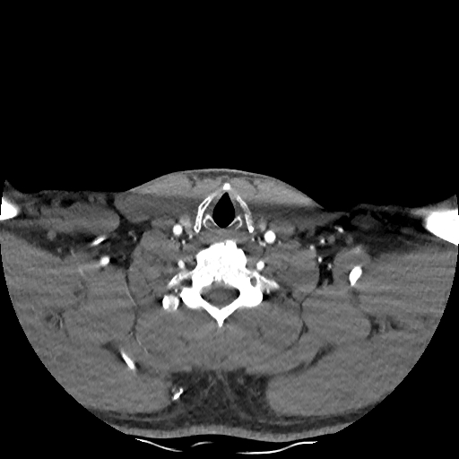 Buccal fat pad arteriovenous malformation (Radiopaedia 70936-81144 D 79).jpg