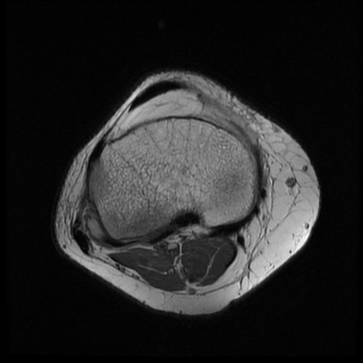 File:Bucket handle meniscus tear (Radiopaedia 56916-63751 Axial PD 15).jpg
