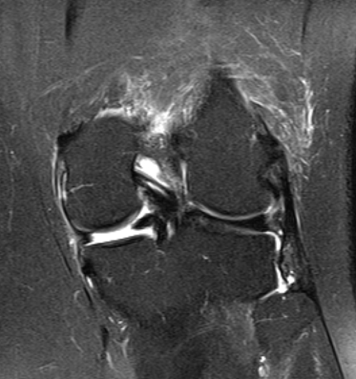 File:Bucket handle tear - medial meniscus (Radiopaedia 79028-91942 Coronal PD fat sat 6).jpg