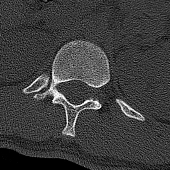 Burst fracture (Radiopaedia 53373-59357 Axial bone window 3).jpg