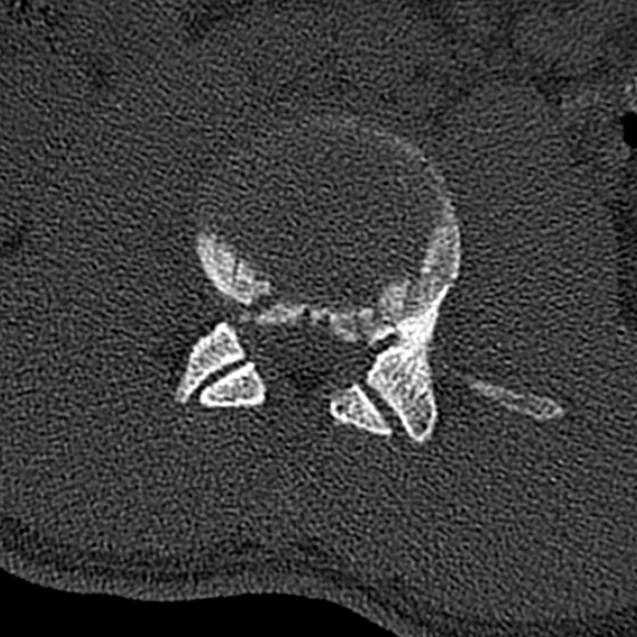 Burst fracture (Radiopaedia 53373-59357 Axial bone window 30).jpg