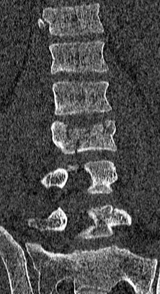 Burst fracture (Radiopaedia 53373-59357 Coronal bone window 39).jpg