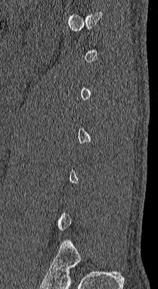 Burst fracture (Radiopaedia 53373-59357 Sagittal bone window 3).jpg