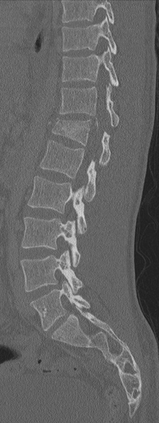 Burst fracture - T12 with conus compression (Radiopaedia 56825-63647 Sagittal bone window 35).png