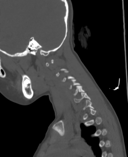 File:Butterfly vertebra (Radiopaedia 77903-90209 Sagittal bone window 98).jpg