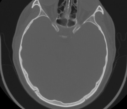 C7 laminar fracture and Klippel-Feil syndrome (Radiopaedia 86710-102850 Axial bone window 2).jpg