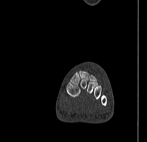 Calcaneal fracture - Sanders type 4 (Radiopaedia 90179-107370 Coronal bone window 40).jpg