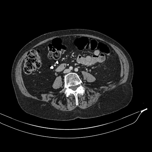 Calcified adrenal glands and Spigelian hernia (Radiopaedia 49741-54988 A 131).jpg