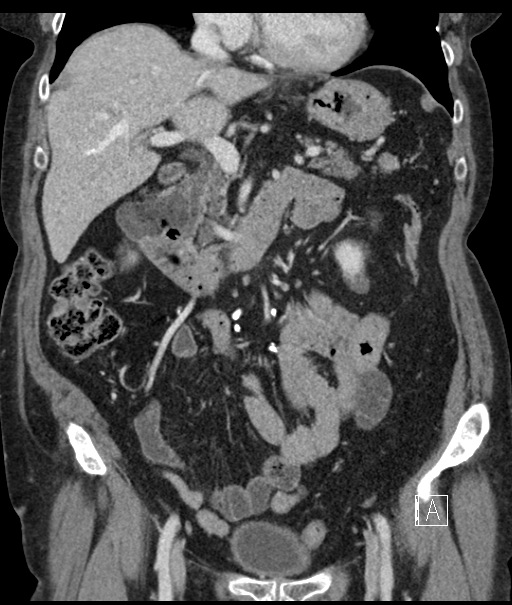 Calcified adrenal glands and Spigelian hernia (Radiopaedia 49741-54988 B 47).jpg