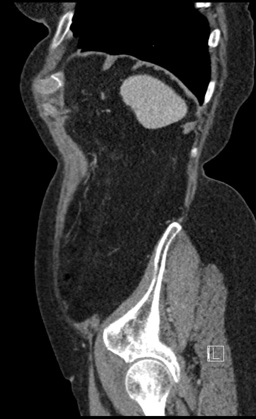 Calcified adrenal glands and Spigelian hernia (Radiopaedia 49741-54988 C 26).jpg