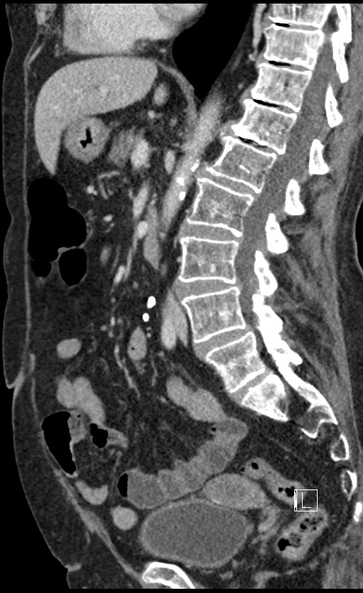 Calcified adrenal glands and Spigelian hernia (Radiopaedia 49741-54988 C 85).jpg