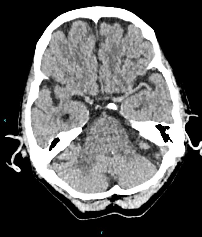 Calcified cerebral emboli from left ventricular thrombus (Radiopaedia 84420-99758 Axial non-contrast 68).jpg