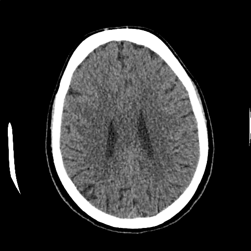 File:Calcified cerebral hydatid cyst (Radiopaedia 65603-74717 Axial non-contrast 50).jpg