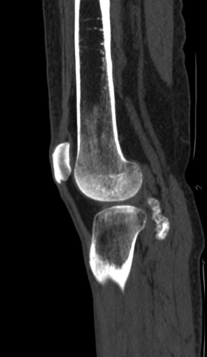 Calcified hematoma - popliteal fossa (Radiopaedia 63938-72763 Sagittal bone window 89).jpg