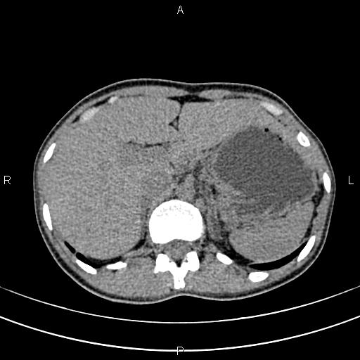 File:Calcified hepatic hydatid cyst (Radiopaedia 83870-99072 Axial non-contrast 44).jpg
