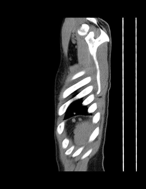 Calcifying pulmonary metastases (Radiopaedia 33359-34396 C 3).jpg