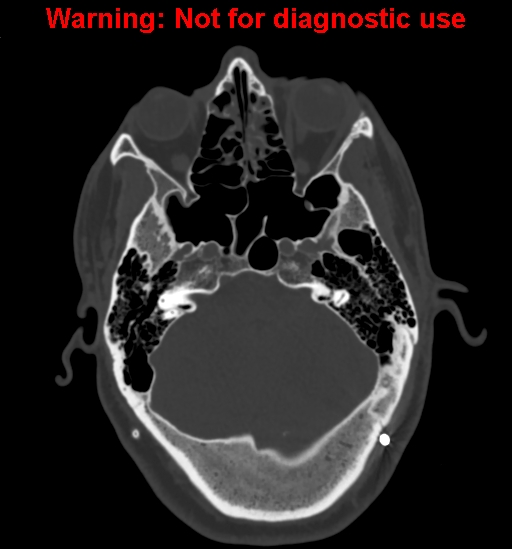 File:Calvarial thickening from chronic shunting (Radiopaedia 60079-67637 Axial bone window 46).jpg