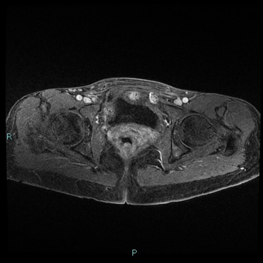 File:Canal of Nuck cyst (Radiopaedia 55074-61448 Axial T1 C+ fat sat 41).jpg