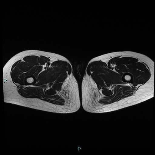 File:Canal of Nuck cyst (Radiopaedia 55074-61448 Axial T2 28).jpg