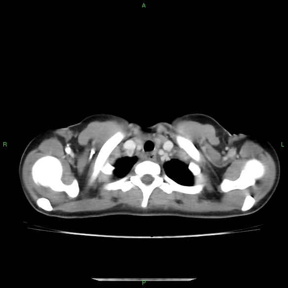 File:Cannon ball metastases - synovial sarcoma (Radiopaedia 26135-26271 C 4).jpg