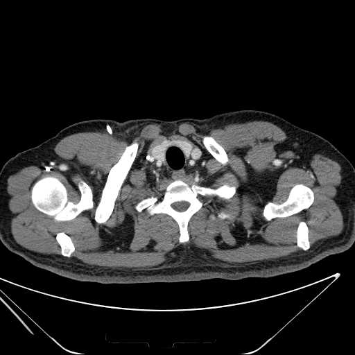 File:Cannonball pulmonary metastases (Radiopaedia 67684-77101 D 12).jpg