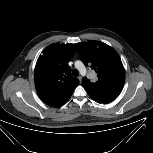 File:Cannonball pulmonary metastases (Radiopaedia 67684-77101 D 87).jpg