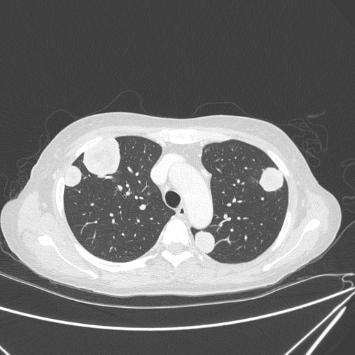 Canonball lung metastasis (Radiopaedia 77634-89837 Axial lung window 53).jpg