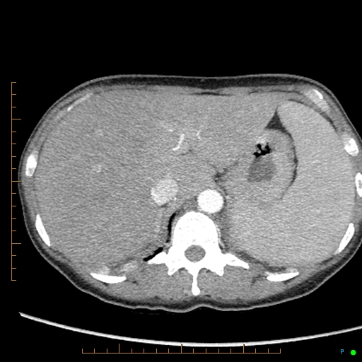 Canonball lung metastasis (Radiopaedia 77634-89837 B 98).jpg