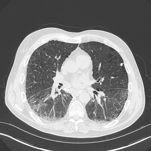 Caplan syndrome (Radiopaedia 56667-63530 Axial lung window 109).jpg